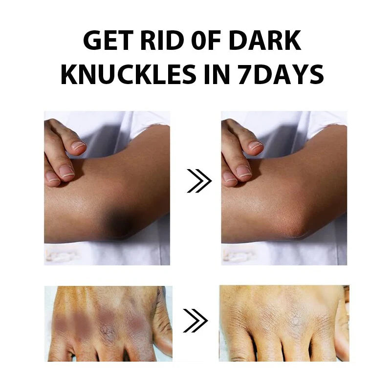 Whitening & Brightening Skin Cream – For Knuckles, Knees, and Elbows