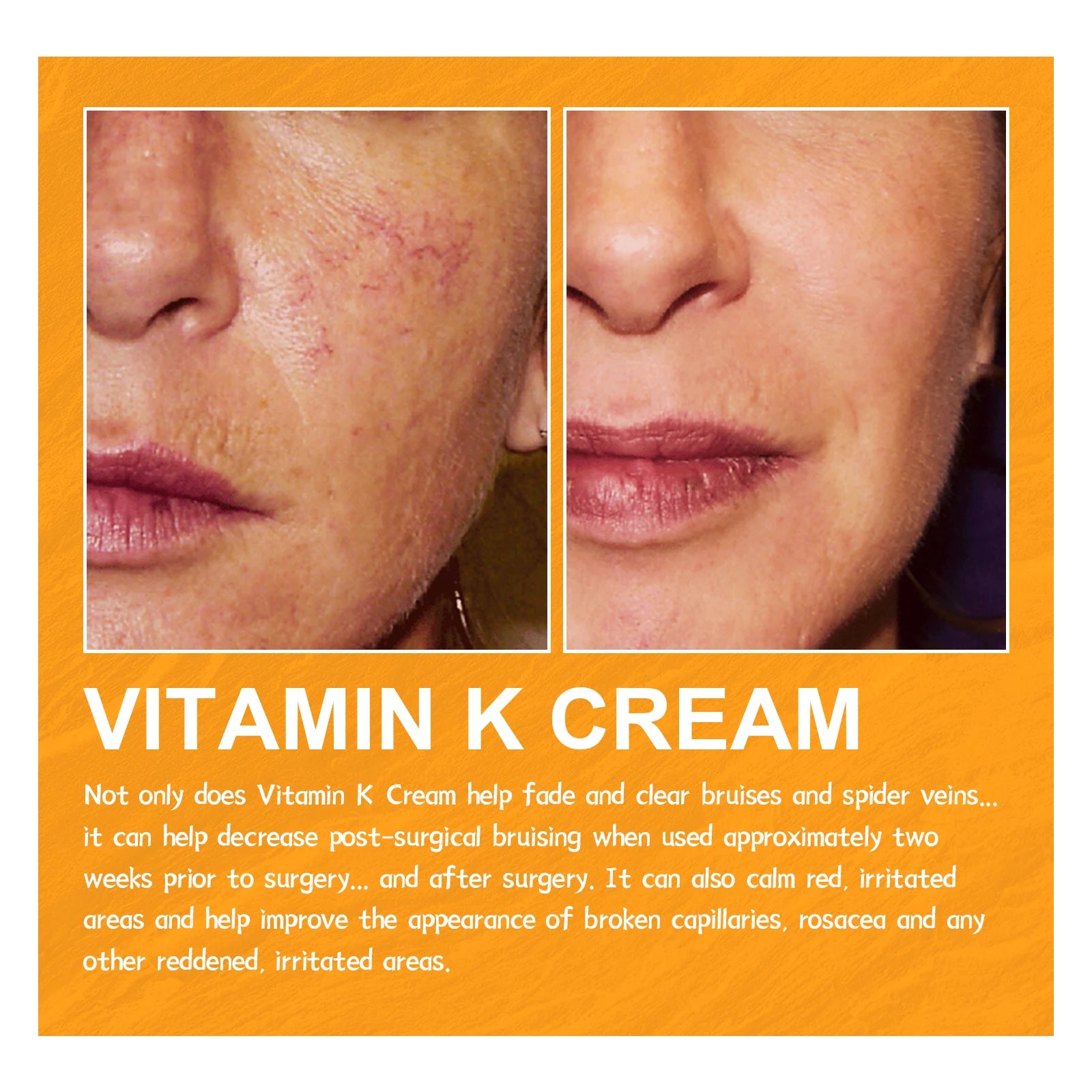 EELHOE Vitamin K Herbal Vein Care Cream